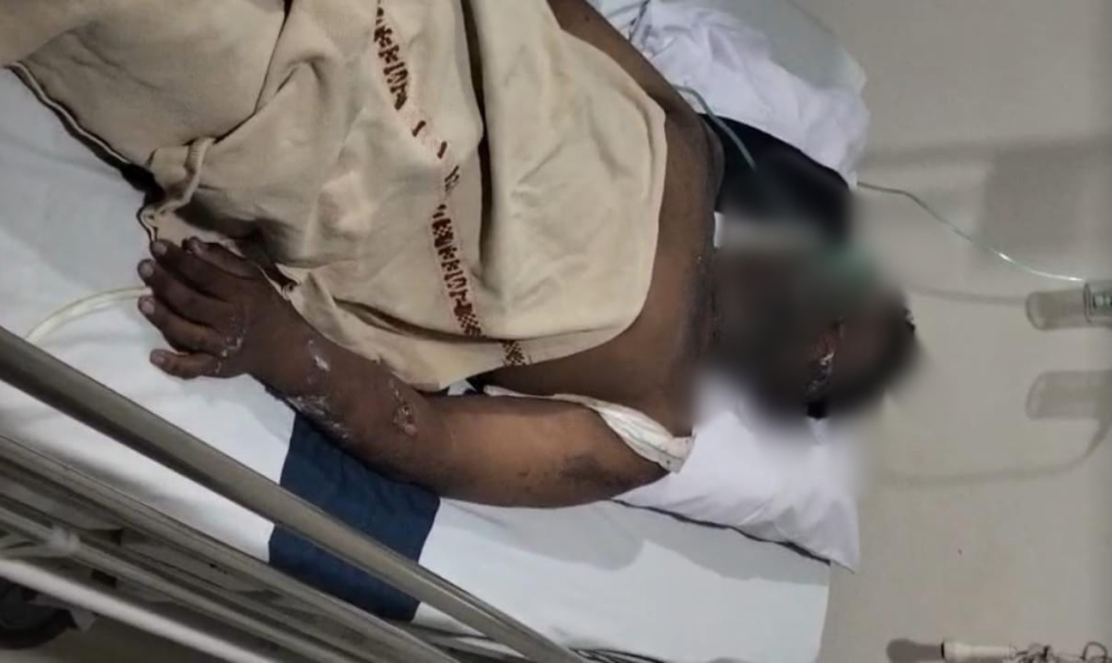 TERBAKAR - Konsisi KAP siswa kelas 9 salah satu SMP Negeri di Kecamatan Prambon yang mengalami luka bakar serius mulai wajah hingga dada korban serta tangan kanan dan kiri korban kemarin.