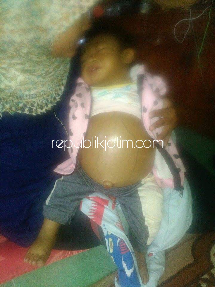 KANKER HATI - Kondisi Wahyu Fajar Gunawan (13 bulan) anak kedua pasangan suami istri, Siska dan Oktavian warga Desa Sadang, Kecamatan Taman, Kabupaten Sidoarjo sangat memperihatinkan karena perutnya membesar sejak 4 bulan terakhir, Selasa (12/12/2017).